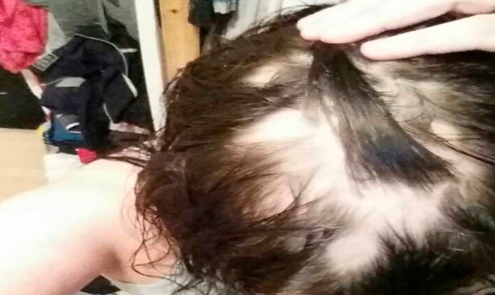 Sorriso: Mulher fica quase careca após cabeleireira “testar” novo produto para deixar cabelo “bonito e sedoso”