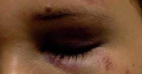 Ipiranga do Norte: Jovem é agredida por mãe e filho só porque estava passando perto da suspeita durante festa da virada de ano