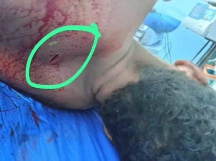 MT: Preso do semiaberto, com tornozeleira, é espancado por populares e preso por suspeita de estupro coletivo