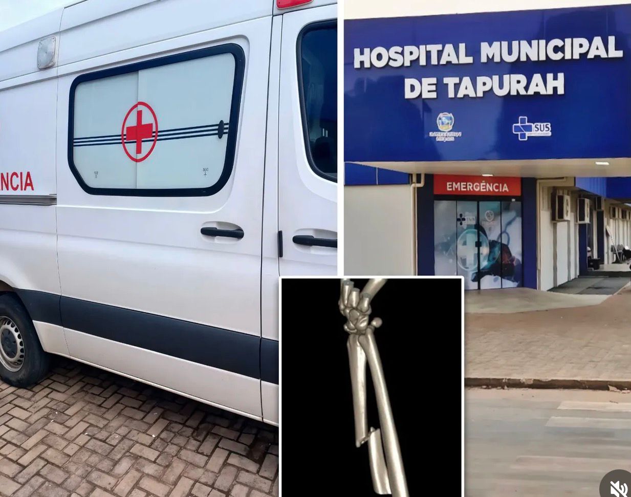 Tapurah: Técnica de enfermagem quebra o braço após motorista “arrancar” ambulância com a porta aberta