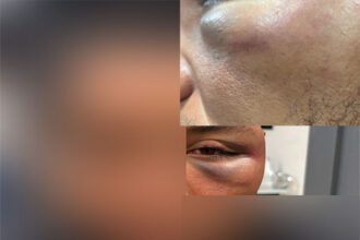 Sorriso: Homem leva murro no olho após dizer que era PT durante discussão em conveniência