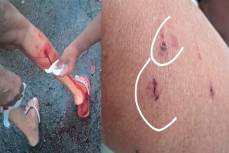 Sorriso: Idosa é atacada por cachorro solto no Bela Vista e fica com perna parecendo “torneira” após mordida atingir veia